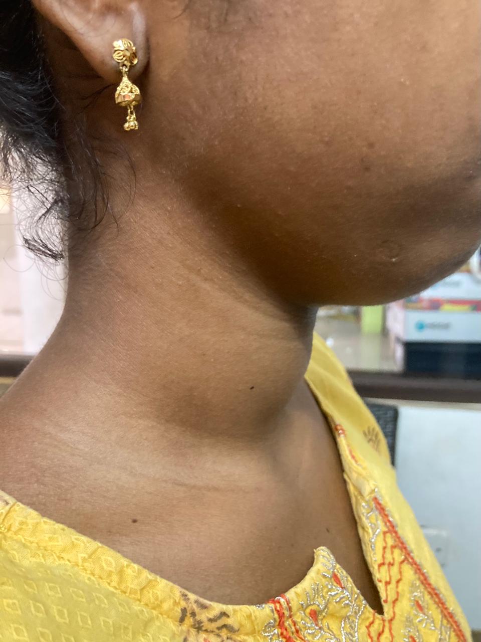 Autoimmune Thyroiditis — Before