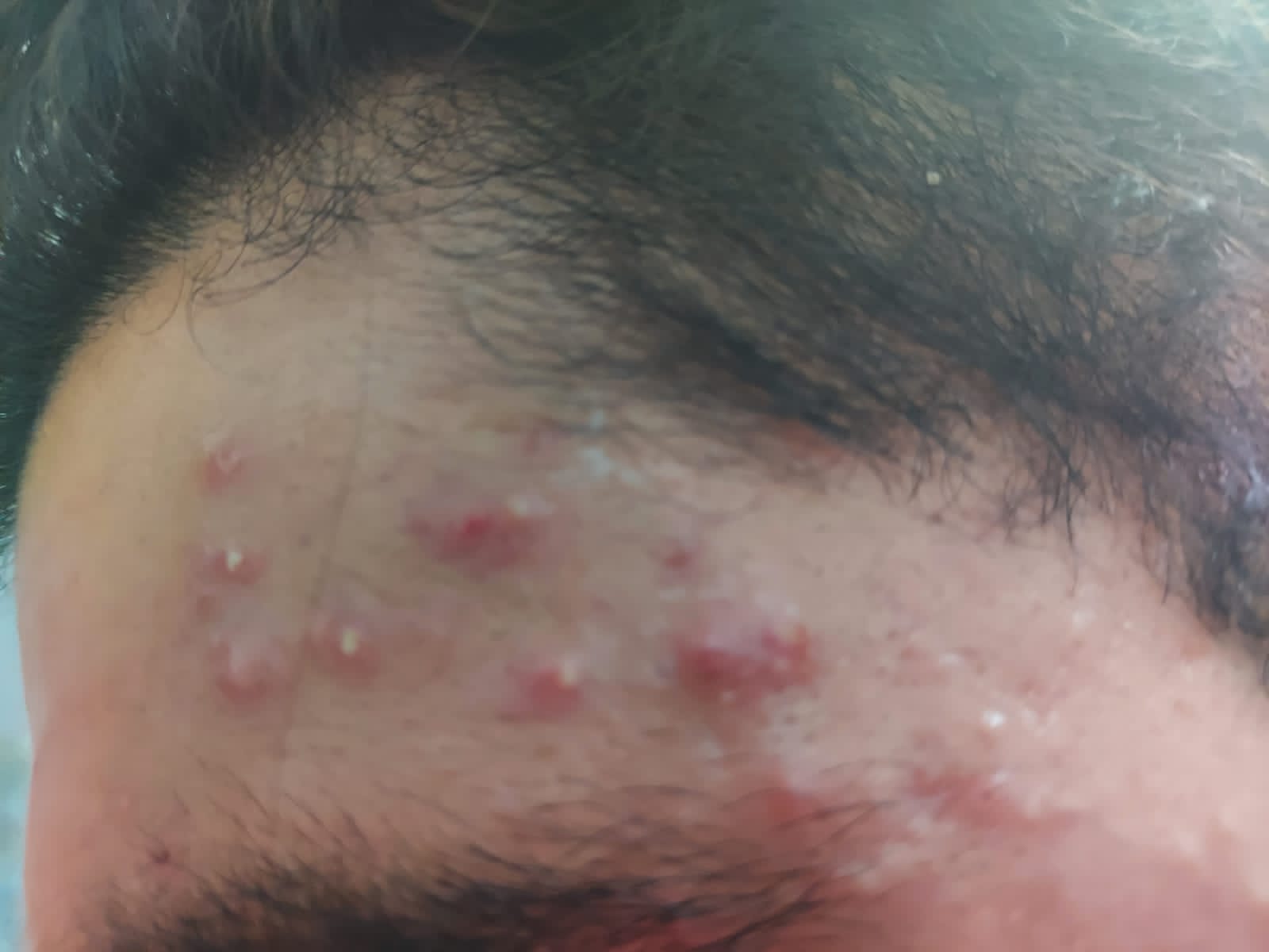 Acne — Before