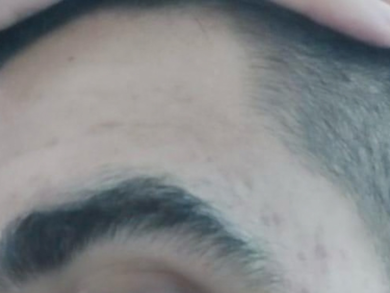 Acne — After